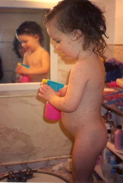 chickenpox2.jpg